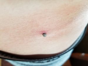 マダニに刺された実際の写真です。